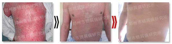 周文静治疗案例