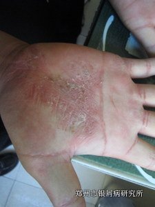 常见的牛皮癣病因有什么