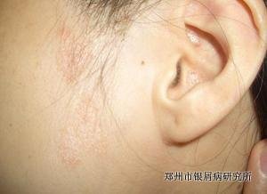 牛皮癣的治疗方法有哪些