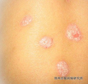 怎么诊断牛皮癣