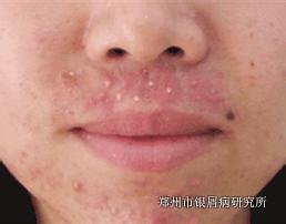 引起牛皮癣的病因有哪些