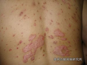 牛皮癣的危害表现在哪些地方