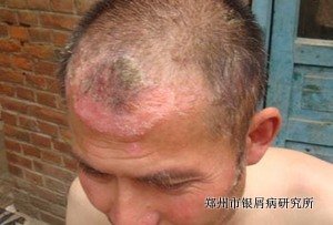 银屑病的危害