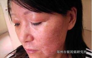早期牛皮癣的护理方法有哪些