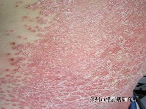 牛皮癣的诊断特征有哪些呢