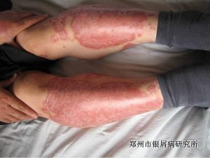 郑州有治疗牛皮癣最好的医院吗